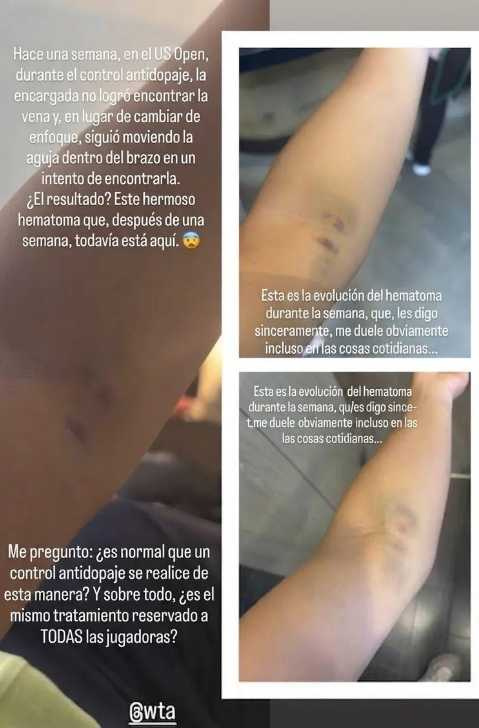 斯特凡尼尼在社群平台Instagram曬出手臂瘀傷的照片。（圖／翻攝自Instagram／lucrezia_stefanini）